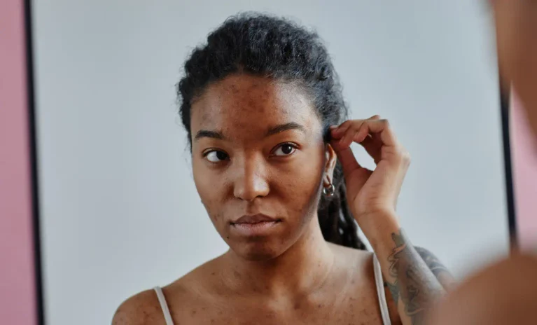 Woman with acne-prone skin examining her face in a mirror.